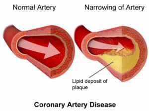 Atherosclerosis diagnosis and management
